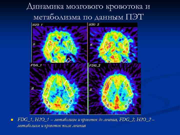 Динамика мозгового кровотока и метаболизма по данным ПЭТ n FDG_1, H 2 O_1 –