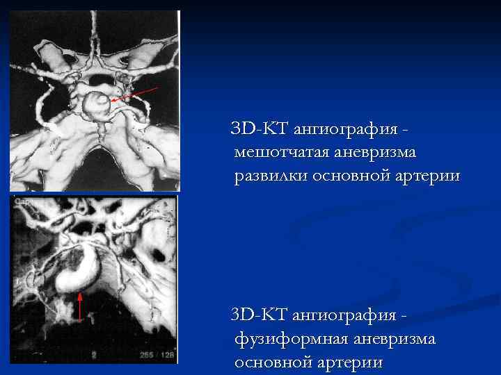ЗD-KT ангиография мешотчатая аневризма развилки основной артерии 3 D-KT ангиография фузиформная аневризма основной артерии