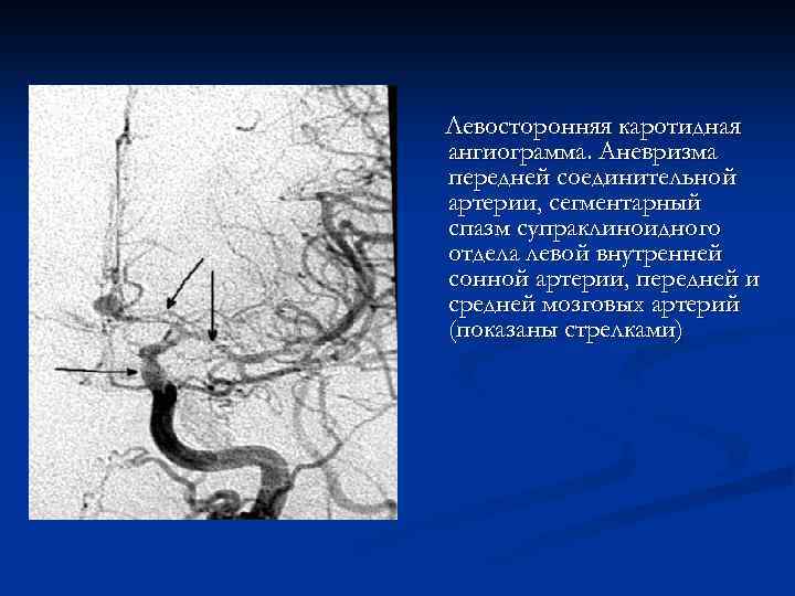 Левосторонняя каротидная ангиограмма. Аневризма передней соединительной артерии, сегментарный спазм супраклиноидного отдела левой внутренней сонной