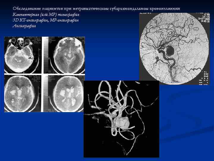 Обследование пациентов при нетравматическом субарахноидальном кровоизлиянии Компьютерная (или МР) томография 3 D КТ-ангиография, МР-ангиография