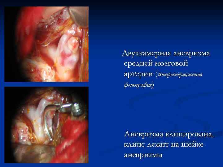 Двухкамерная аневризма средней мозговой артерии (интраоперационная фотография) Аневризма клипирована, клипс лежит на шейке аневризмы