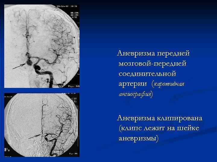 Аневризма передней мозговой-передней соединительной артерии (каротидная ангиография) Аневризма клипирована (клипс лежит на шейке аневризмы)