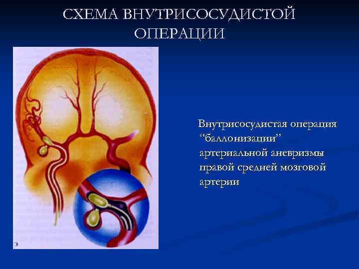 СХЕМА ВНУТРИСОСУДИСТОЙ ОПЕРАЦИИ Внутрисосудистая операция “баллонизации” артериальной аневризмы правой средней мозговой артерии 