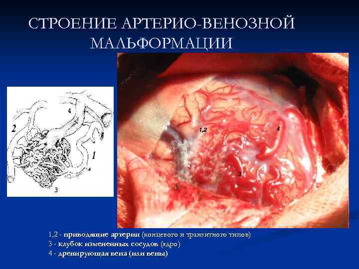 СТРОЕНИЕ АРТЕРИО-ВЕНОЗНОЙ МАЛЬФОРМАЦИИ 1, 2 - приводящие артерии (концевого и транзитного типов) 3 -