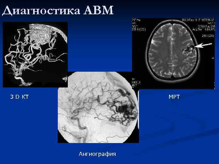 Диагностика АВМ 3 D КТ МРТ Ангиография 