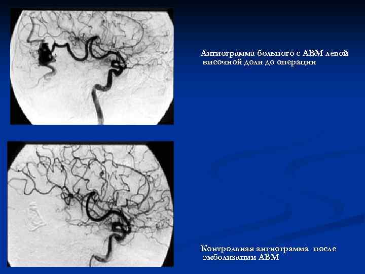 Ангиограмма больного с АВМ левой височной доли до операции Контрольная ангиограмма после эмболизации АВМ