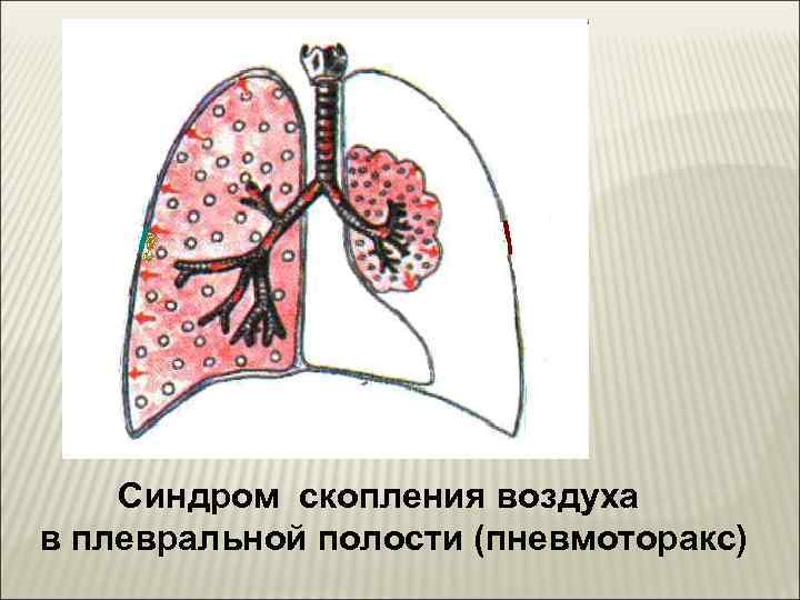 Физикальная картина при пневмотораксе характеризуется