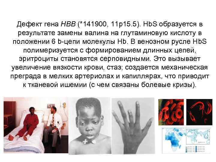 Дефект гена HBB (*141900, 11 p 15. 5). Hb. S образуется в результате замены