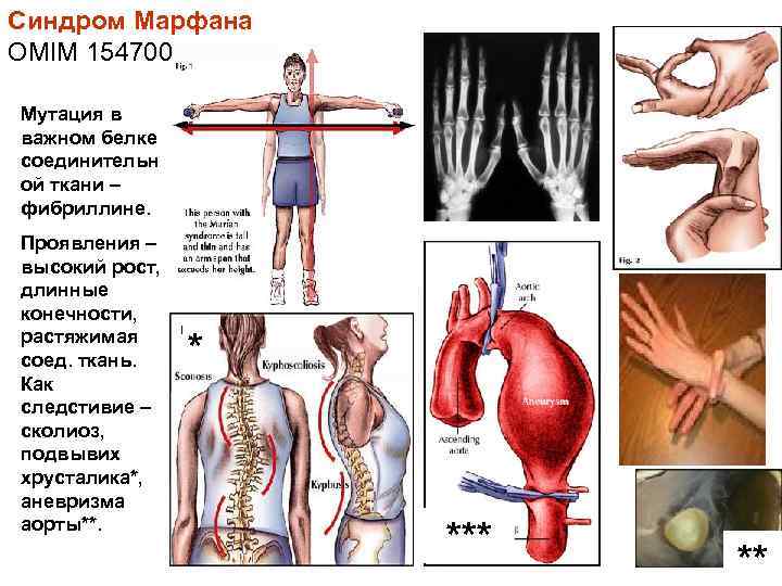 Синдром Марфана OMIM 154700 Мутация в важном белке соединительн ой ткани – фибриллине. Проявления