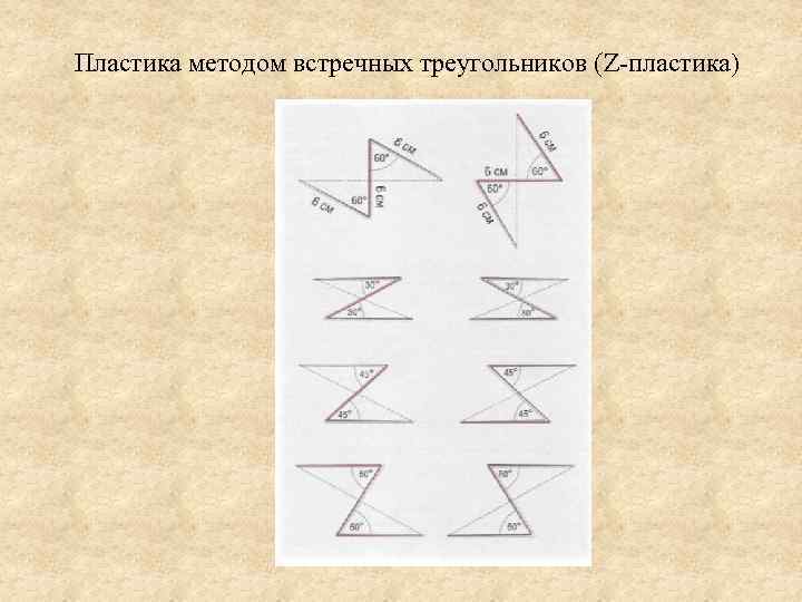 Пластика методом встречных треугольников (Z-пластика) 