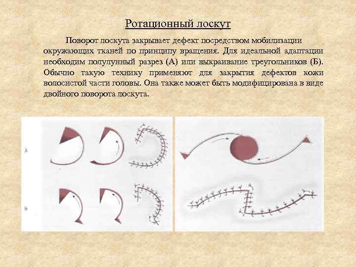 Принцип лоскута. Ротационный кожные лоскуты. Пластика ротационным лоскутом. Методика ротационного лоскута. Методика закрытия дефекта ротационными лоскутами..