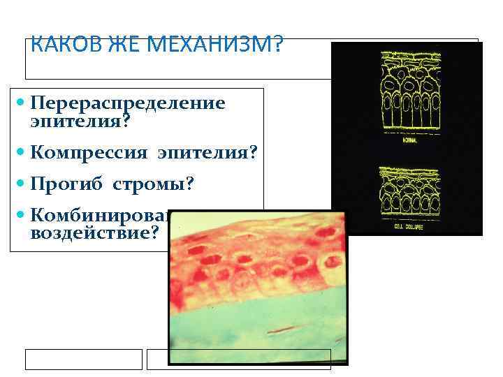 КАКОВ ЖЕ МЕХАНИЗМ? Перераспределение эпителия? Компрессия эпителия? Прогиб стромы? Комбинированное воздействие? 