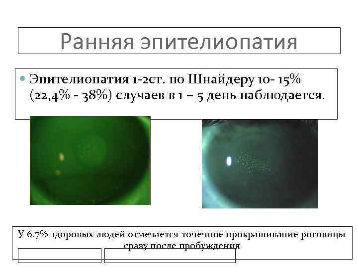 Ранняя эпителиопатия Эпителиопатия 1 -2 ст. по Шнайдеру 10 - 15% (22, 4% -