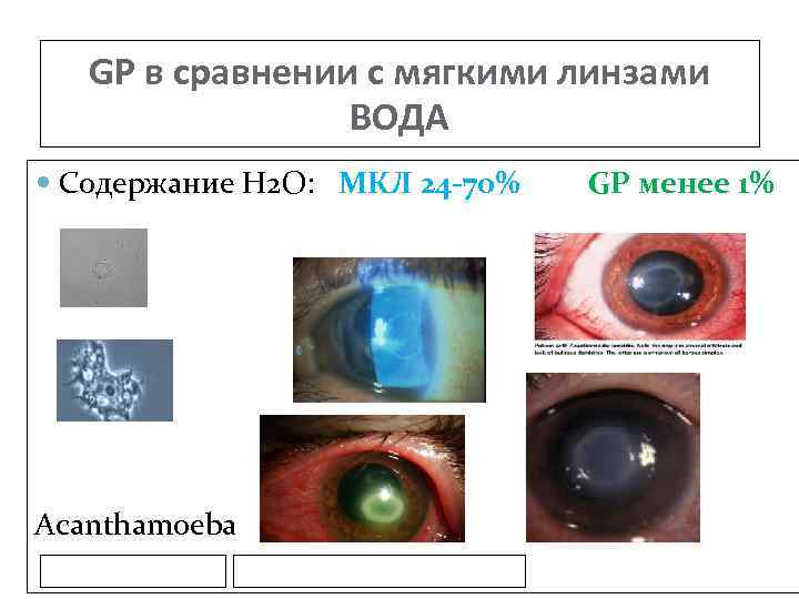 GP в сравнении с мягкими линзами ВОДА Содержание H 2 O: МКЛ 24 -70%
