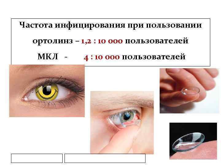 Частота инфицирования при пользовании ортолинз – 1, 2 : 10 000 пользователей МКЛ -