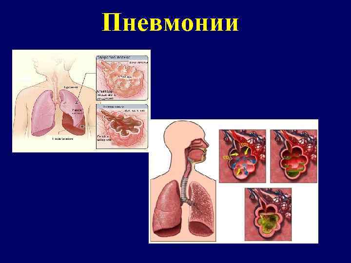 Пневмонии 