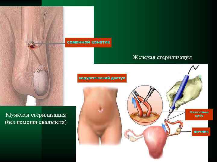 семенной канатик Женская стерилизация хирургический доступ Мужская стерилизация (без помощи скальпеля) Фаллопиева труба яичник