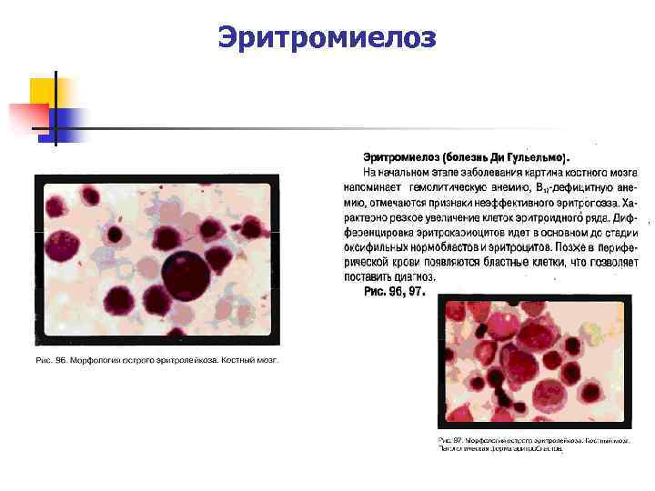 Эритромиелоз картина крови