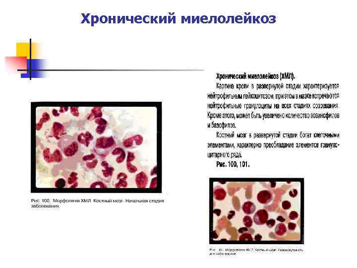 Хронический нейтрофильный лейкоз картина крови