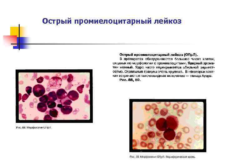 Лейкозы пропедевтика презентация