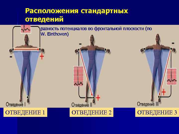 Расположения стандартных отведений разность потенциалов во фронтальной плоскости (по W. Einthoven) ОТВЕДЕНИЕ 1 ОТВЕДЕНИЕ
