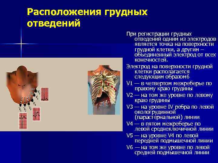 Расположения грудных отведений При регистрации грудных отведений одним из электродов является точка на поверхности