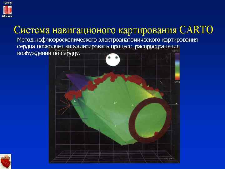 Метод нефлюороскопического электроанатомического картирования сердца позволяет визуализировать процесс распространения возбуждения по сердцу. 