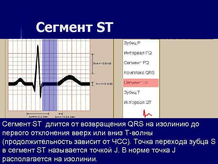 Сегмент ST длится от возвращения QRS на изолинию до первого отклонения вверх или вниз