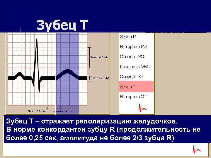 Зубец Т – отражает реполяризацию желудочков. В норме конкордантен зубцу R (продолжительность не более
