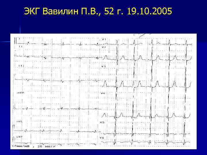 ЭКГ Вавилин П. В. , 52 г. 19. 10. 2005 