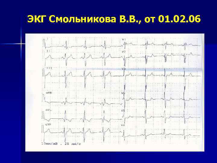 ЭКГ Смольникова В. В. , от 01. 02. 06 