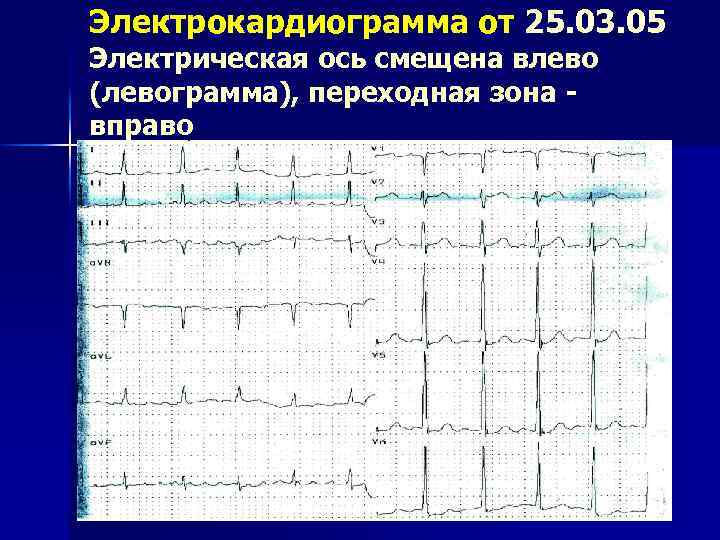 Повышение электрической. Смещение переходной зоны на ЭКГ. Переходная зона в v2 на ЭКГ. ЭКГ сердца переходная зона:v2-v3. Смещение переходной зоны вправо на ЭКГ.