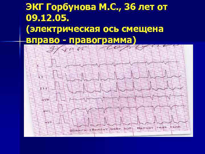 ЭКГ Горбунова М. С. , 36 лет от 09. 12. 05. (электрическая ось смещена