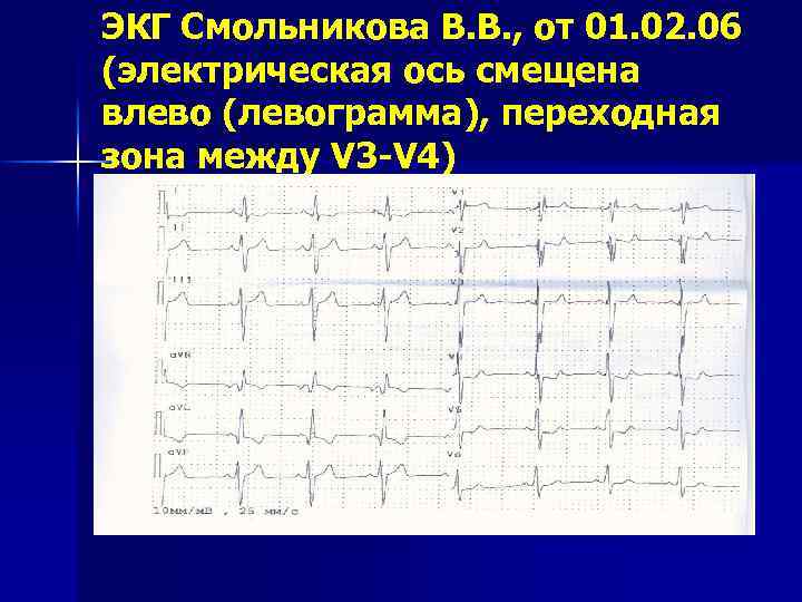 Экг 3. ЭКГ электрическая ось левограмма. ЭКГ Эл ось q3. V4 отведение ЭКГ фибрилляция. Переходная зона v3 что это на ЭКГ.