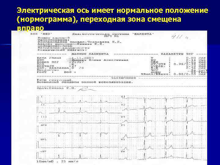Электрическая ось имеет нормальное положение (нормограмма), переходная зона смещена вправо 