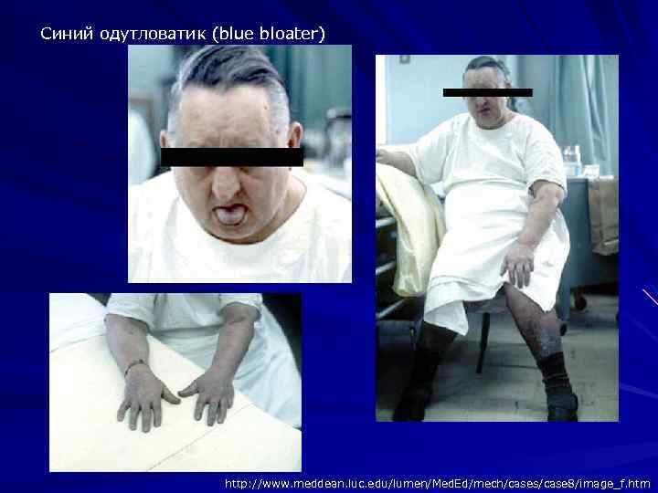 Синий одутловатик (blue bloater) http: //www. meddean. luc. edu/lumen/Med. Ed/mech/cases/case 8/image_f. htm 