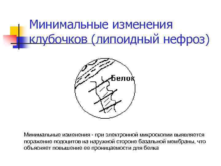 Минимальные изменения клубочков (липоидный нефроз) Минимальные изменения - при электронной микроскопии выявляется поражение подоцитов