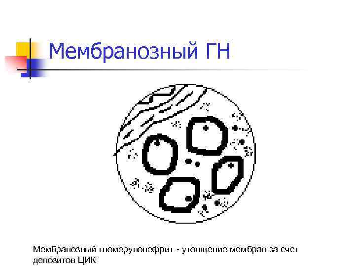 Мембранозный ГН Мембранозный гломерулонефрит - утолщение мембран за счет депозитов ЦИК 