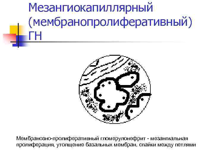 Мезангиокапиллярный (мембранопролиферативный) ГН Мембранозно-пролиферативный гломерулонефрит - мезангиальная пролиферация, утолщение базальных мембран, спайки между петлями
