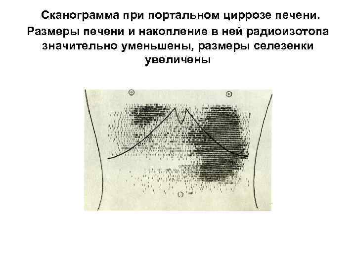 Сканограмма при портальном циррозе печени. Размеры печени и накопление в ней радиоизотопа значительно уменьшены,