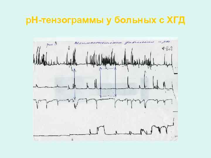 р. Н-тензограммы у больных с ХГД 