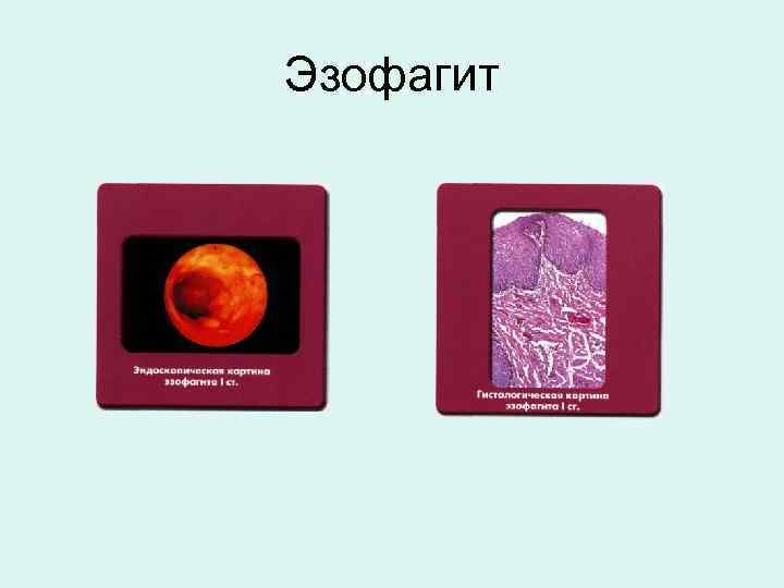 Эзофагит 