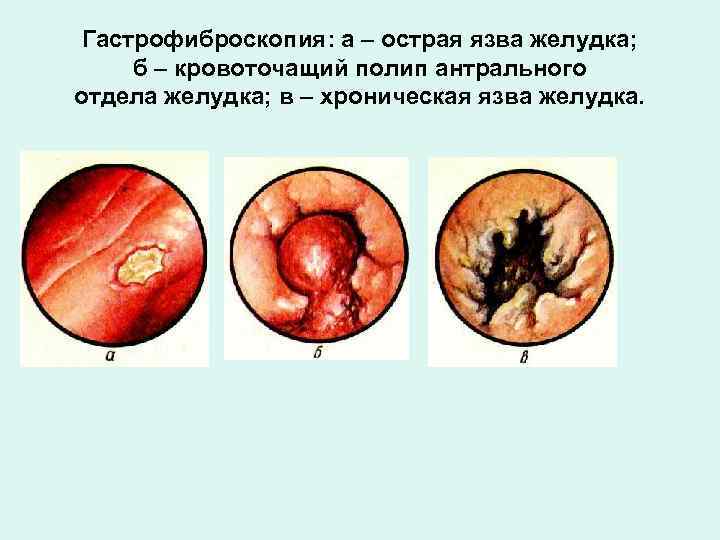 Гастрофиброскопия: а – острая язва желудка; б – кровоточащий полип антрального отдела желудка; в