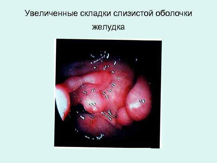 Увеличенные складки слизистой оболочки желудка 
