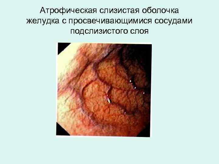 Атрофическая слизистая оболочка желудка с просвечивающимися сосудами подслизистого слоя 
