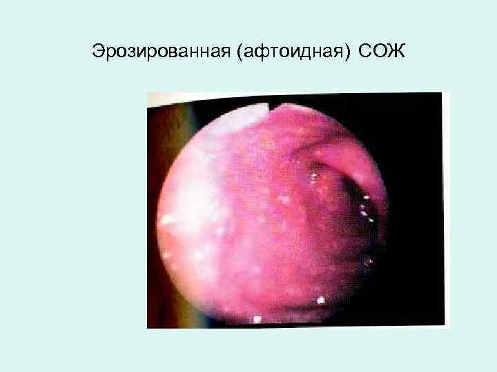 Эрозированная (афтоидная) СОЖ 