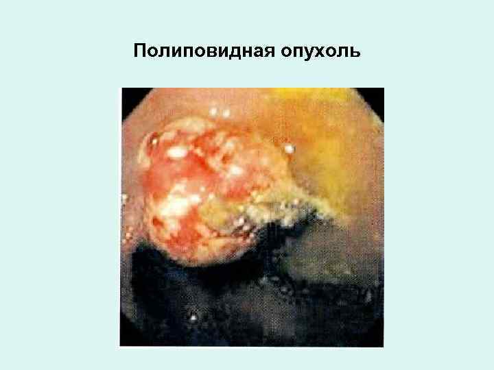 Полиповидная опухоль 