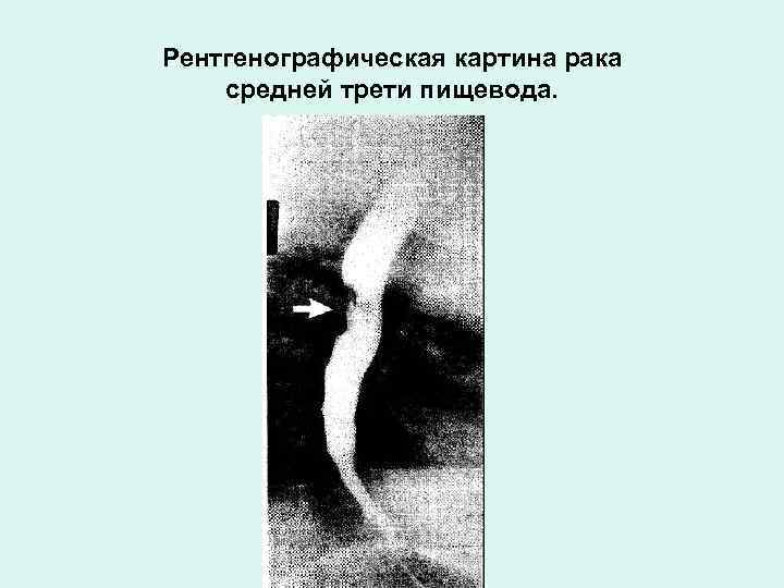 Рентгенографическая картина рака средней трети пищевода. 