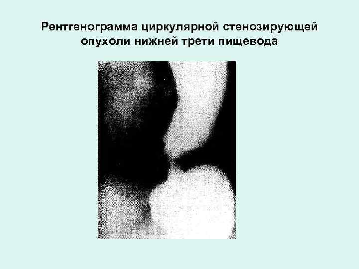 Рентгенограмма циркулярной стенозирующей опухоли нижней трети пищевода 
