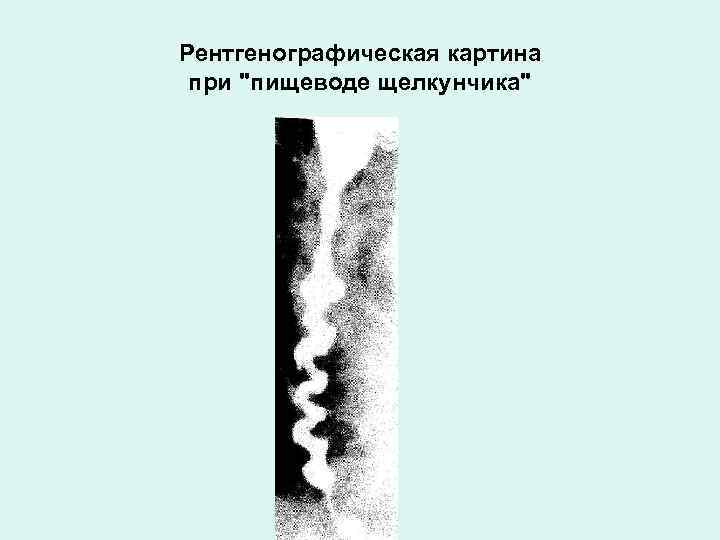 Рентгенографическая картина при "пищеводе щелкунчика" 